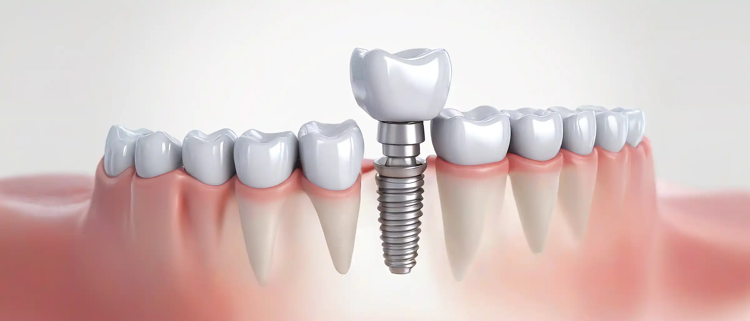 Dental Implants