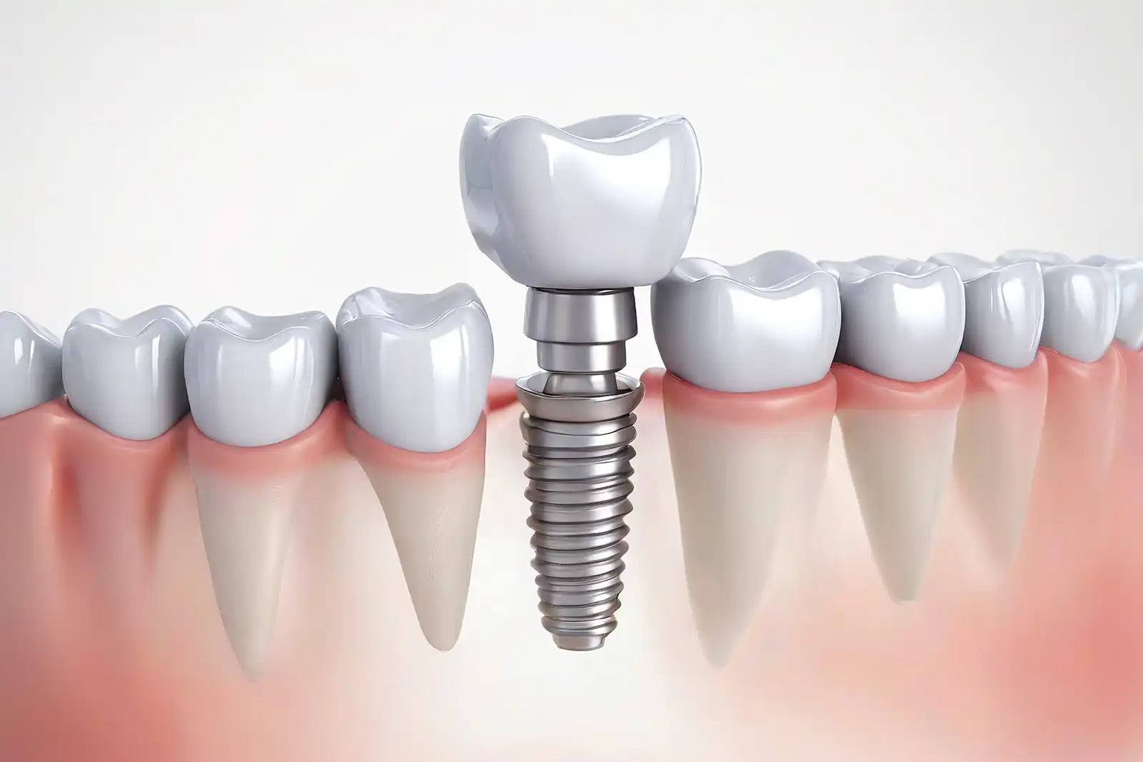 Dental Implants